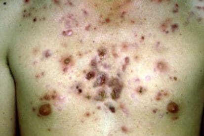 acne-3 (1)