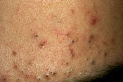 acne-2 (1)
