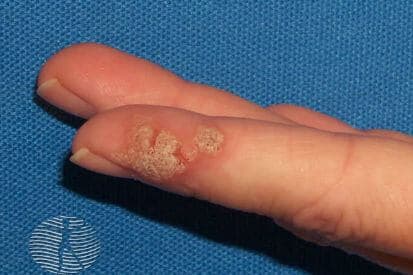pinnacleskin.com /conditions/warts Carousel 1 Image 4