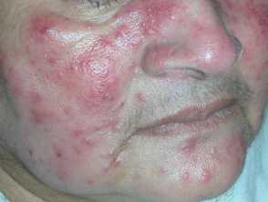 rosacea2